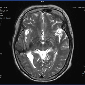 Chảy máu não thất