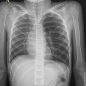 Dị vật đường thở