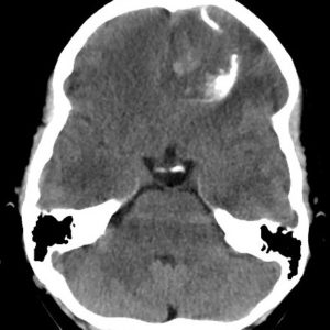 U thần kinh đệm ít nhánh