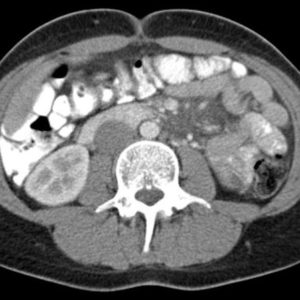 U mạch bạch huyết