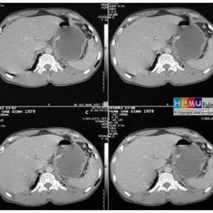 Chấn thương lách