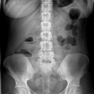 Viêm loét đại tràng