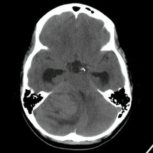 U nguyên bào tủy