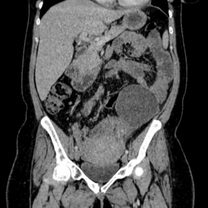 Xoắn buồng trứng