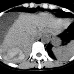 U tuyến tế bào gan