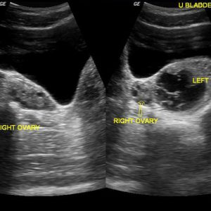 Xoắn buồng trứng
