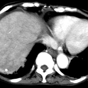 Hội chứng Budd-Chiari