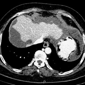 U giả nhầy phúc mạc