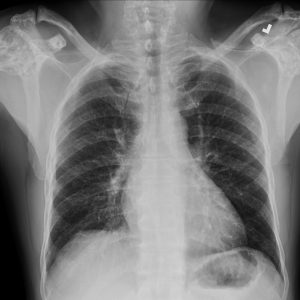 Xương đặc đốm