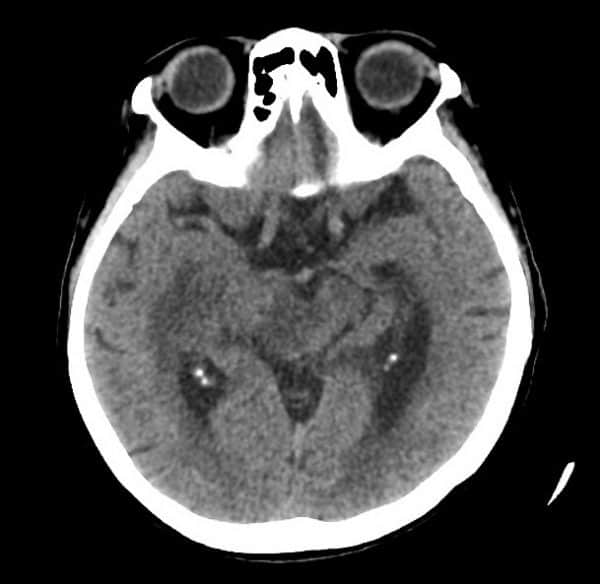 Lymphoma