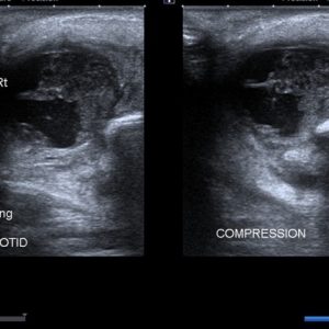 U tuyến nước bọt