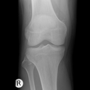 Sarcoma bao hoạt dịch