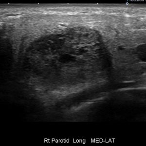 U tuyến nước bọt