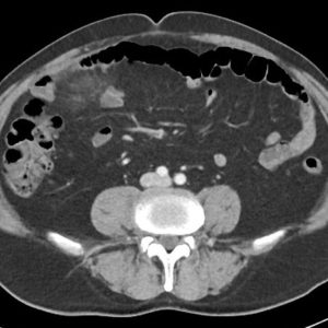 Viêm túi thừa Meckel