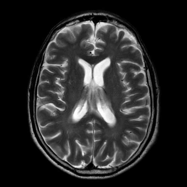 Lymphoma