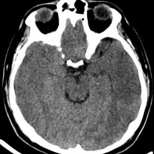 Phù não sau chấn thương