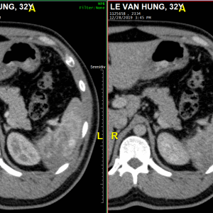 Chấn thương lách