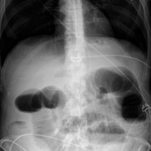 Thiếu máu mạc treo ruột