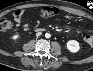 Viêm mạc treo xơ cứng