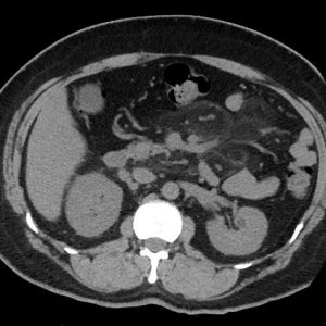 Viêm mạc treo xơ cứng