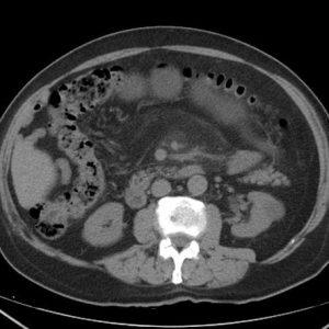 Viêm mạc treo xơ cứng