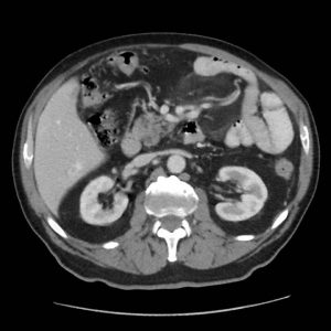 Viêm mạc treo xơ cứng