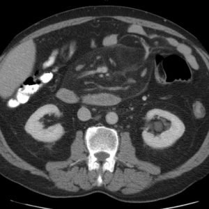 Viêm mạc treo xơ cứng