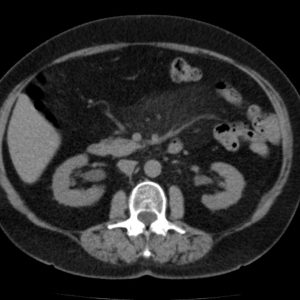 Viêm mạc treo xơ cứng