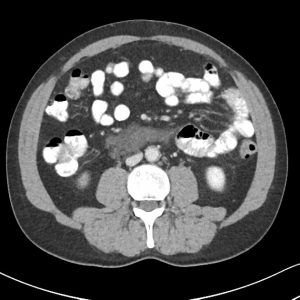 U mạch bạch huyết