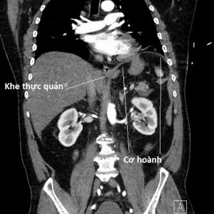 Chấn thương cơ hoành