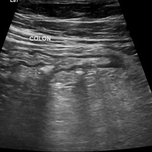 Viêm túi thừa đại tràng