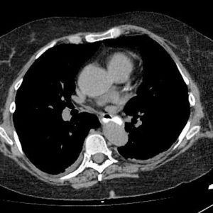 Túi thừa thực quản