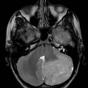 U nguyên bào tủy