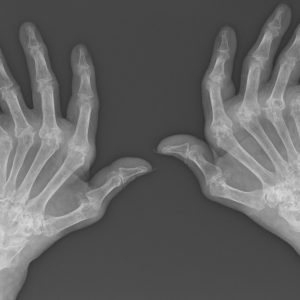 Viêm khớp dạng thấp