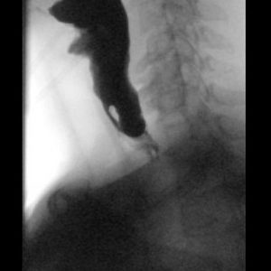 Túi thừa thực quản