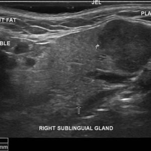 U tuyến nước bọt
