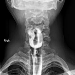 Túi thừa thực quản