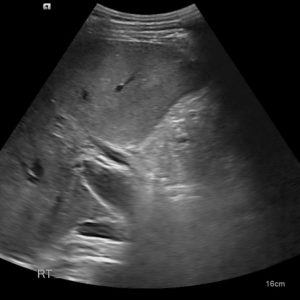 Huyết khối TM cửa