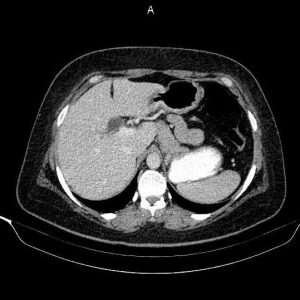 Nang ống mật chủ