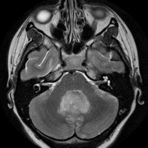 U nguyên bào tủy