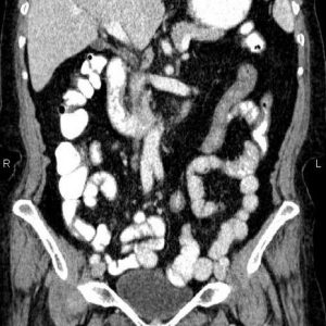 Túi thừa tá tràng