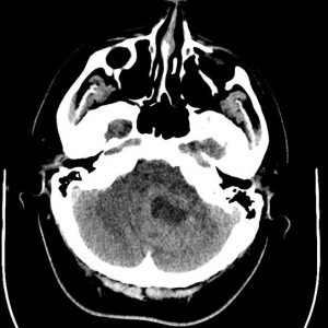 U nguyên bào tủy
