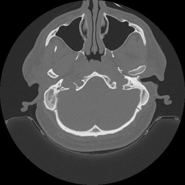 Cholesteatoma