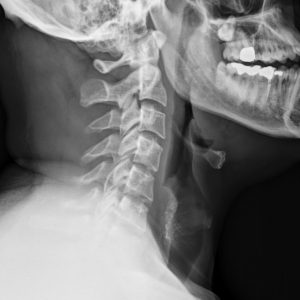 Túi thừa thực quản