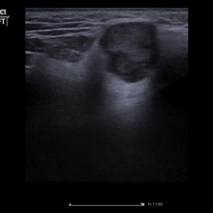 U tuyến nước bọt