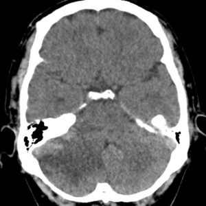 U nguyên bào mạch máu