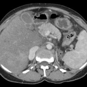 Hội chứng Budd Chiari