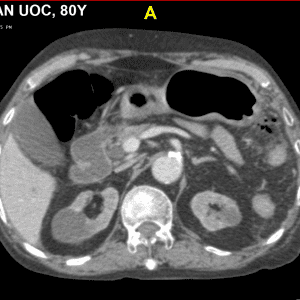 Thủng túi thừa đại tràng