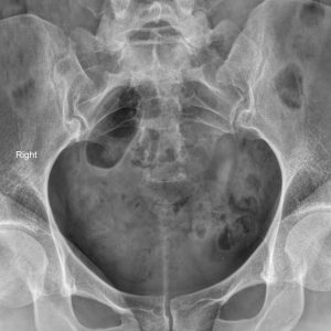 Dị dạng tử cung