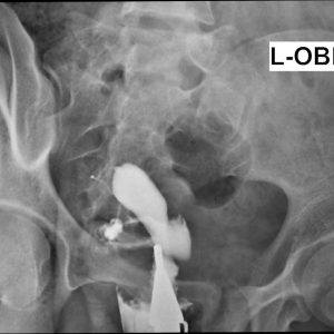 Dị dạng tử cung